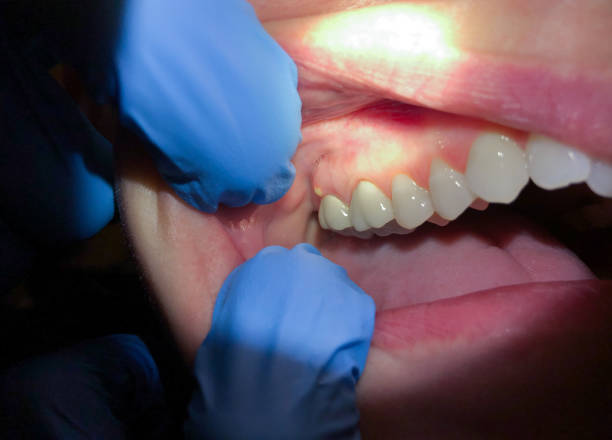 Best Lost Filling or Crown Replacement in Dalton, PA