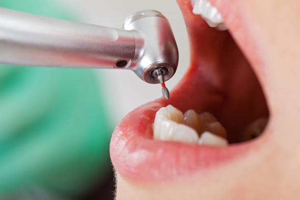 Best Emergency Root Canal Therapy in Dalton, PA